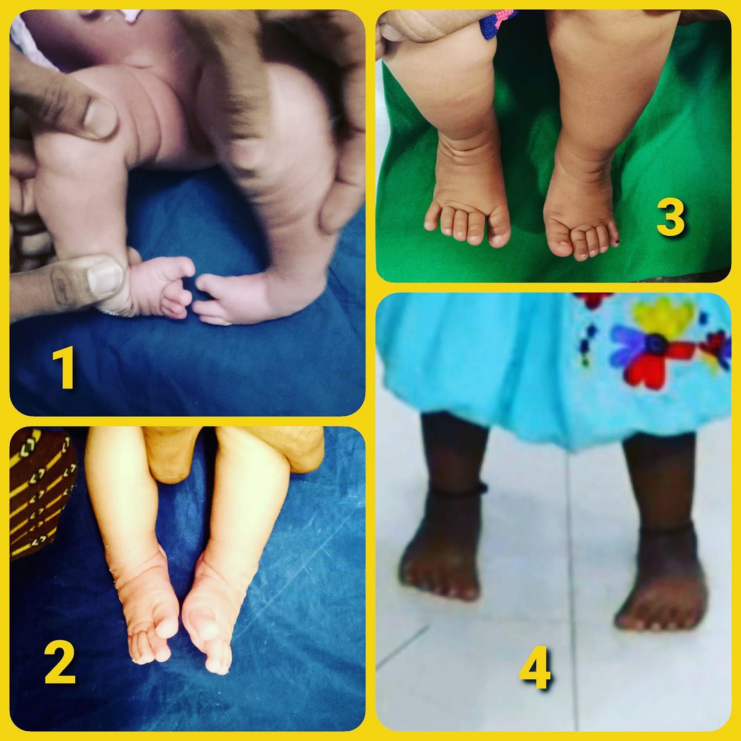 Pediatric foot deformity treatment stages