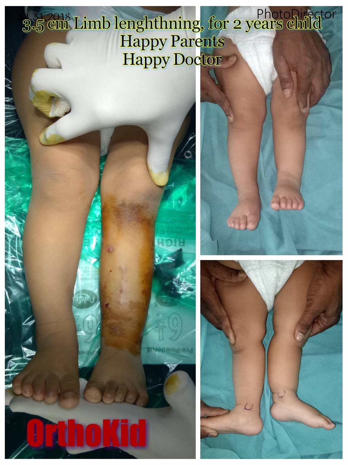 Pediatric limb alignment treatment and follow-up