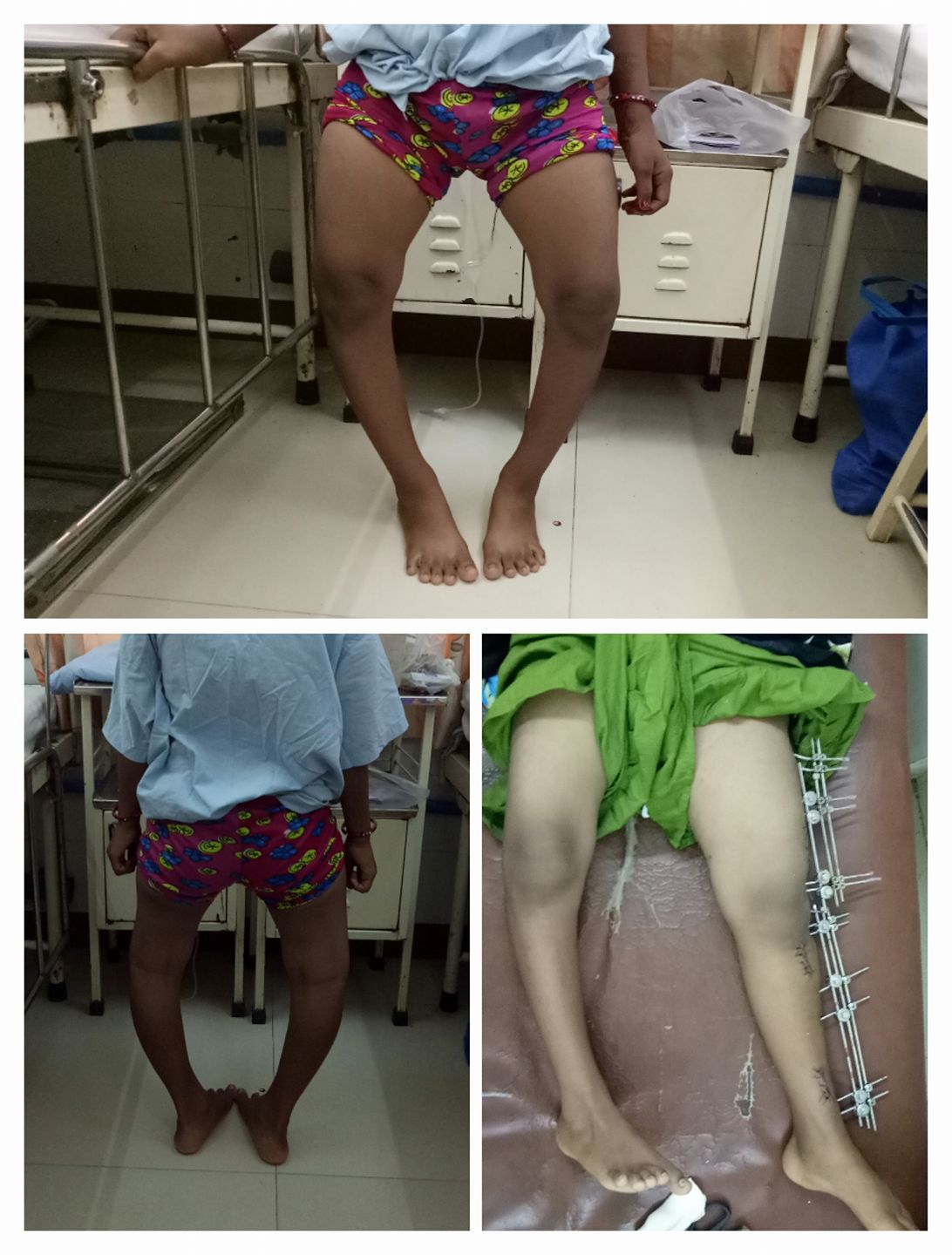 Lower-limb deformity treatment and surgical follow-up