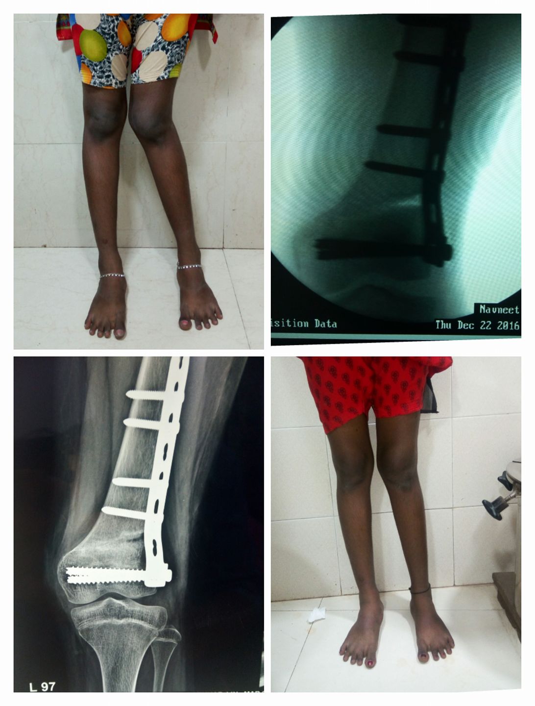 Lower-limb treatment shown through clinical photographs and radiograph