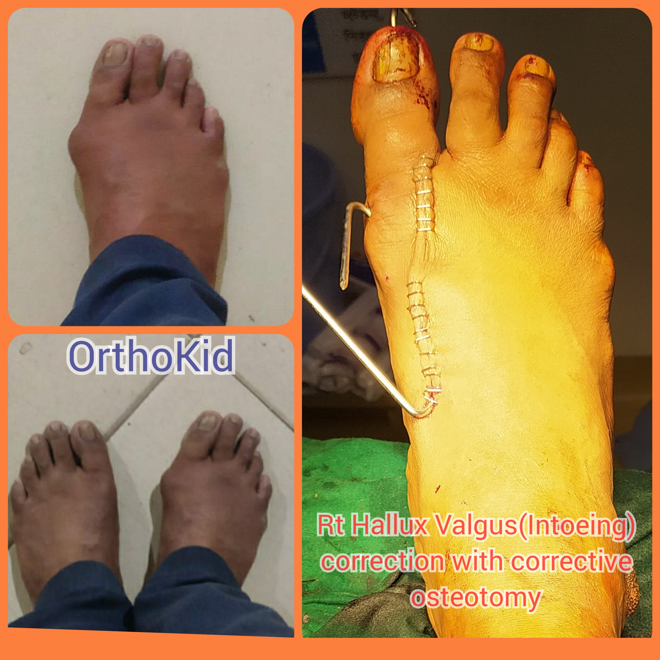 Foot alignment before and after corrective treatment
