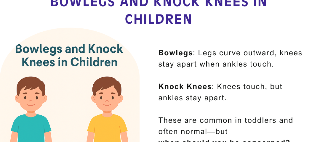 Bow legs & Knock knees in kids