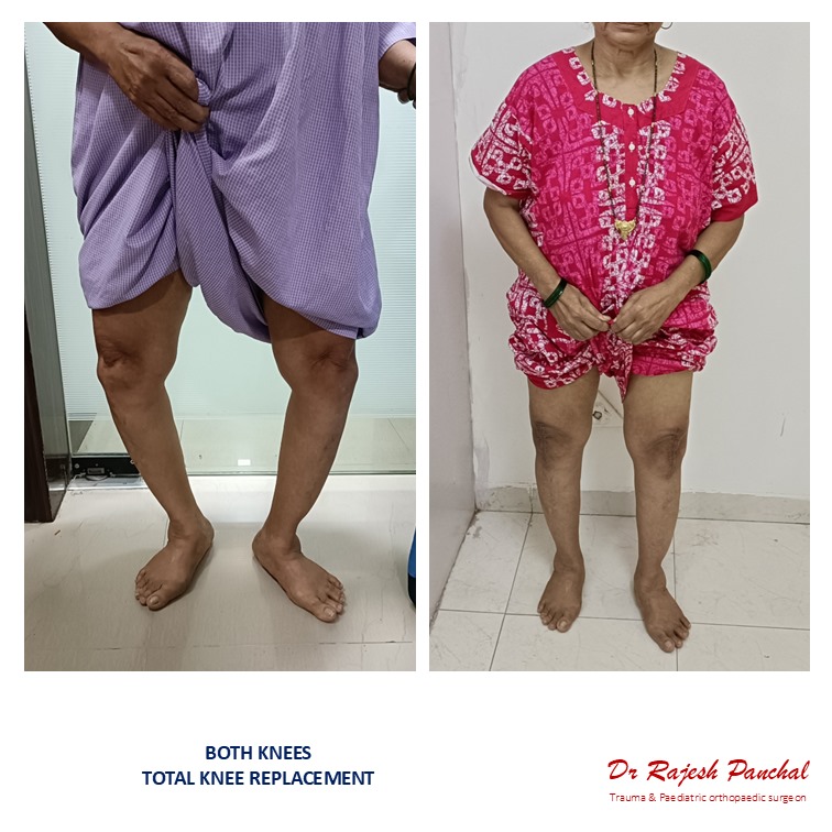 Before and follow-up views of lower-limb alignment